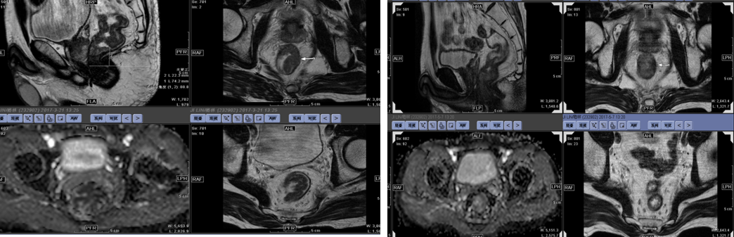 同步放化疗前后直肠病灶.png