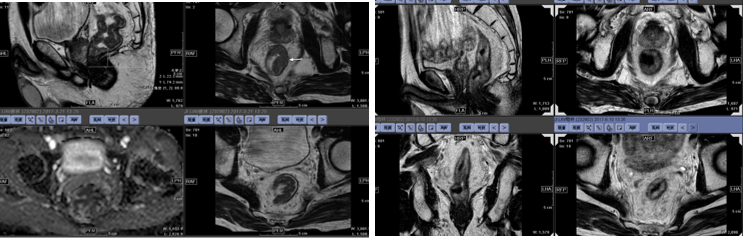 化疗前后直肠病灶.png