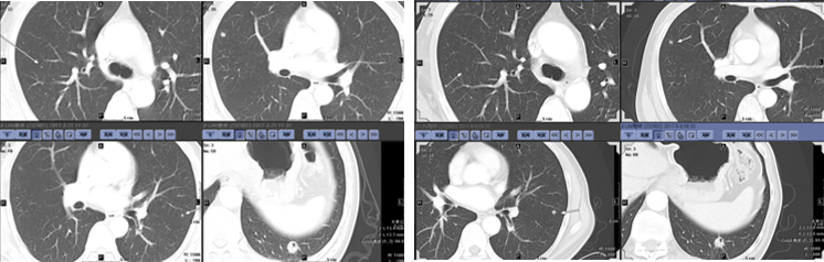 化疗前后肺部病灶.png