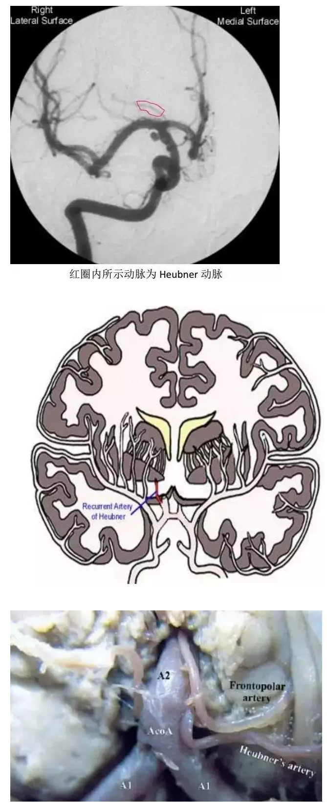 右侧大脑前动脉a1段图片