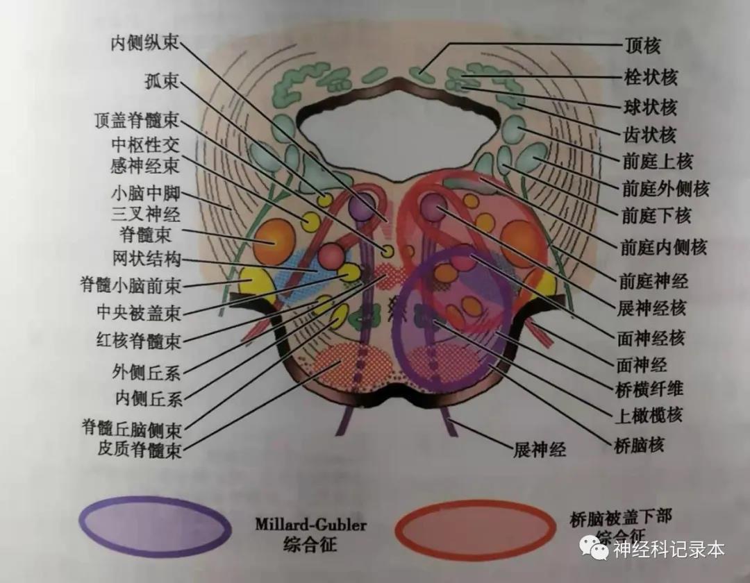 mills征示意图图片