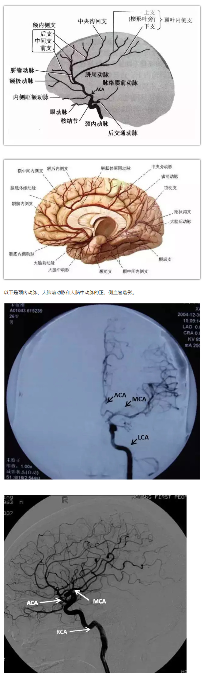 大脑动脉分支图片