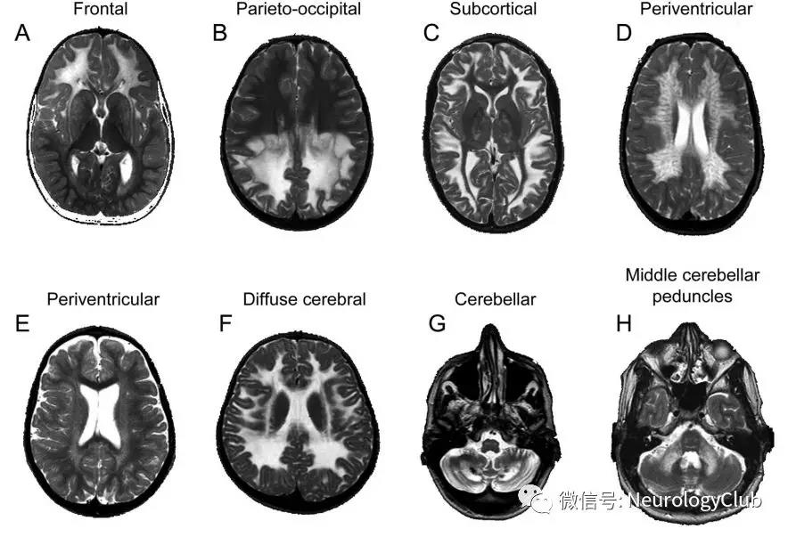 图6脑白质营养不良的病灶分布a:亚历山大病多表现为额叶白质受累为主