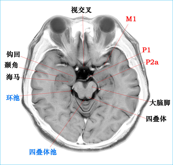 侧脑室断层解剖图图片