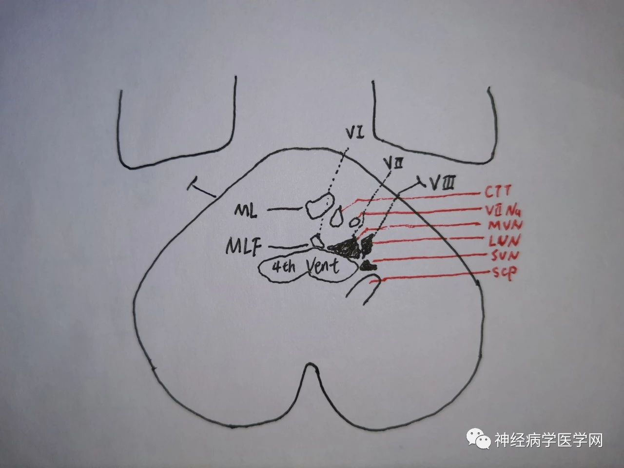 第四腦室(4th vent)底部的前庭神經核(vn) 群[外側核(lvn),內側核