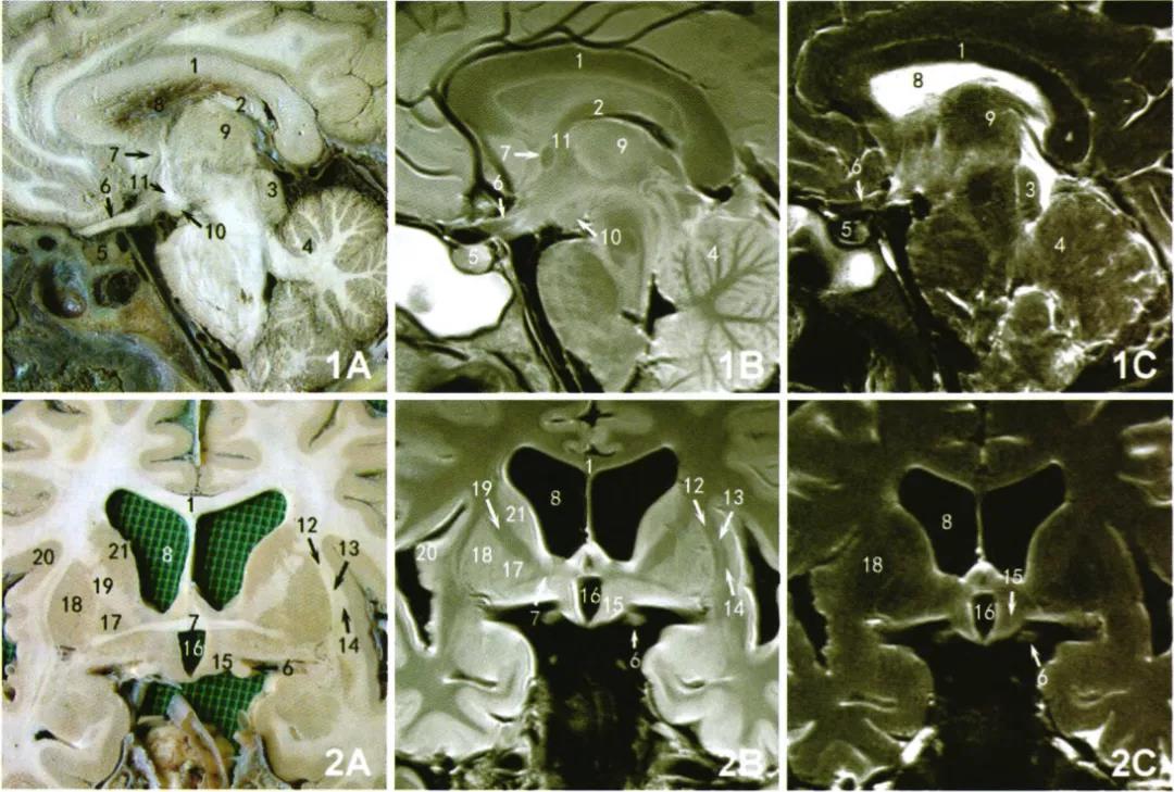 丘脑 解剖 影像图片