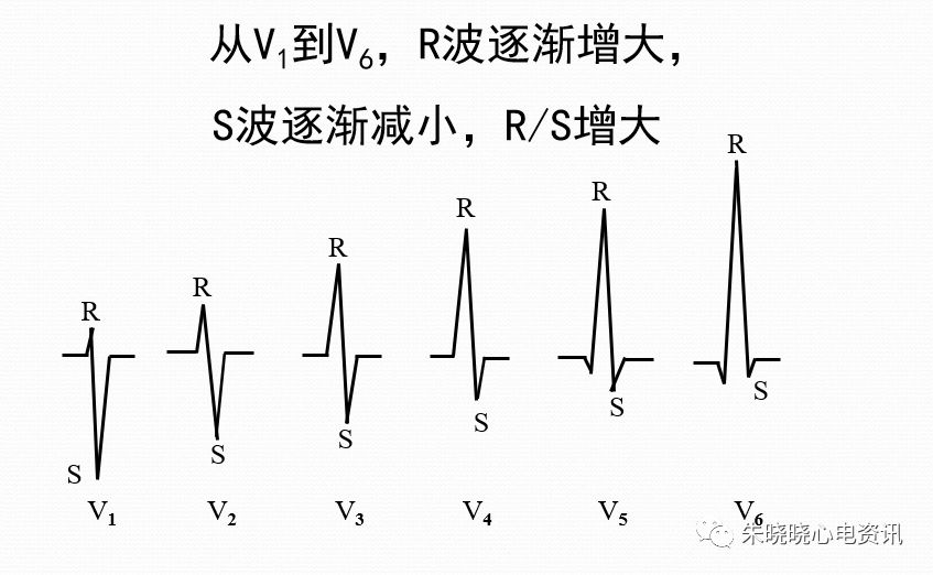心电图r波切迹的意义图片