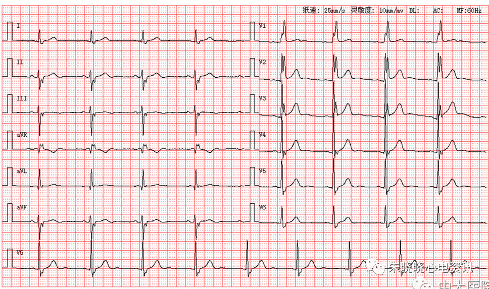 壹生资讯 心电图读图解析 完全性右束支传导阻滞伴左前分支传导阻滞