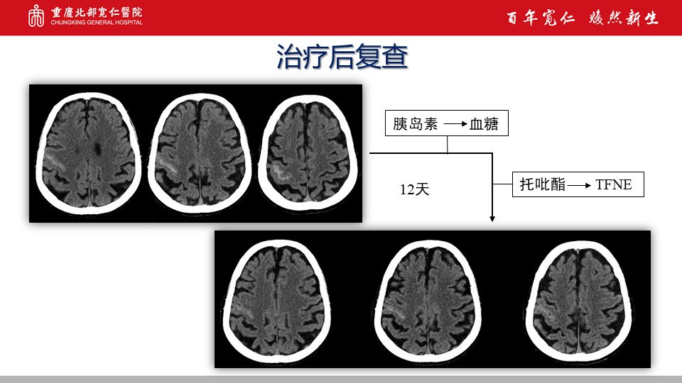 目前沒針對caa的病因治療,治療上主要是避免抗栓藥物的使用,控制血壓