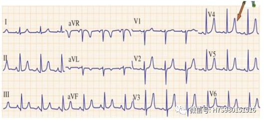 高鉀血癥的心電圖表現