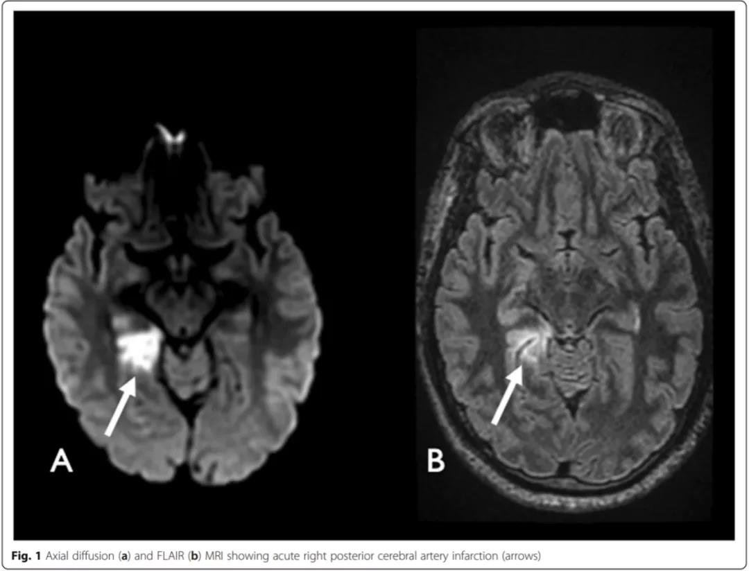 圖1 dwi(a)和flair(b)mri顯示急性右側大腦後動脈梗死(箭頭示)