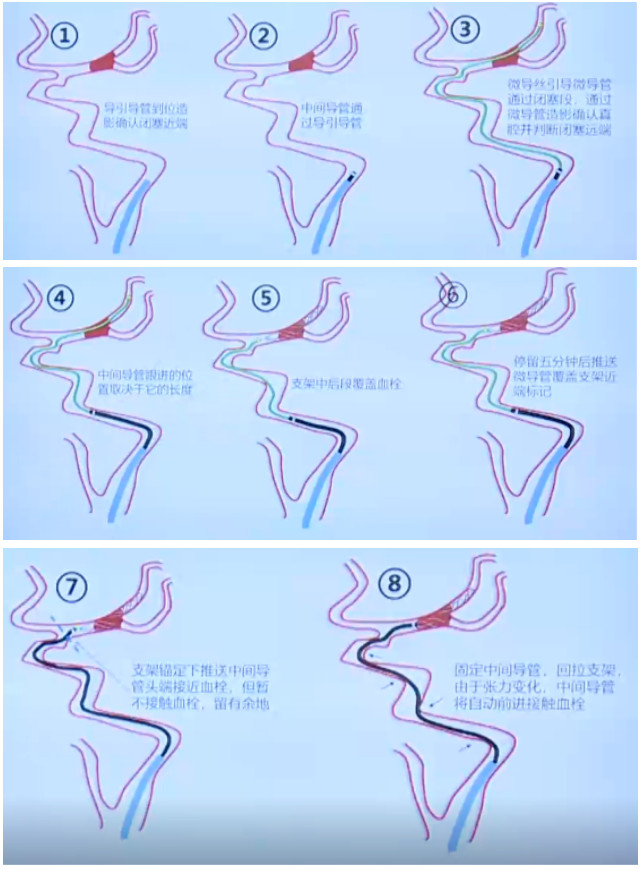 (9) 可将solitaire收入中间导管并经中间导管负压抽吸,中间导管留在原