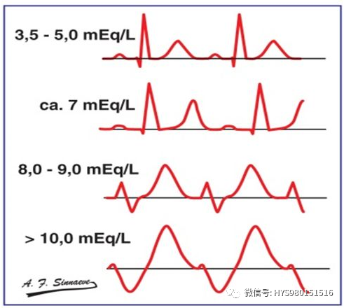 高鉀血癥的心電圖表現