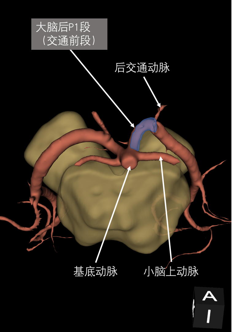 双侧胚胎型大脑后动脉图片