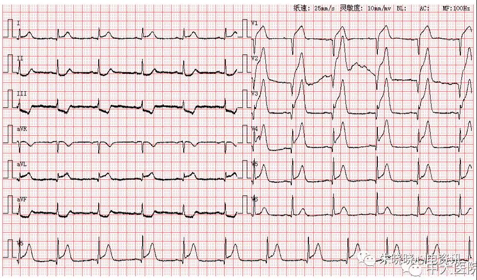 心电图读图解析:急性广泛前壁心肌梗死1例