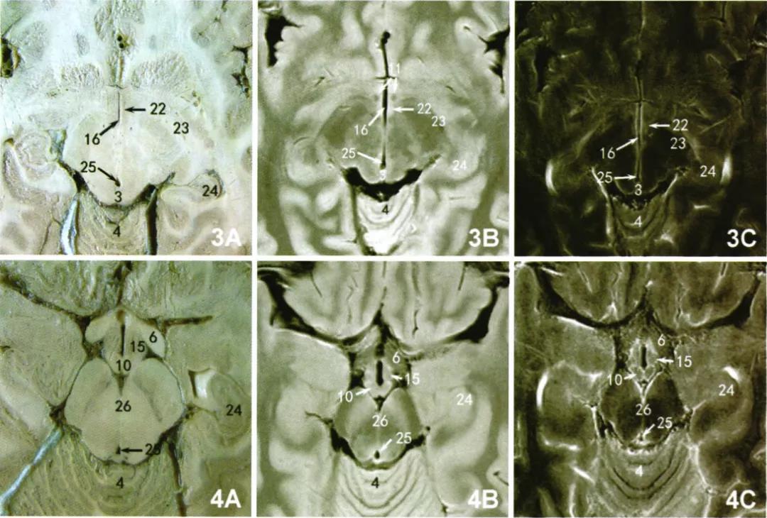 丘脑 解剖 影像图片