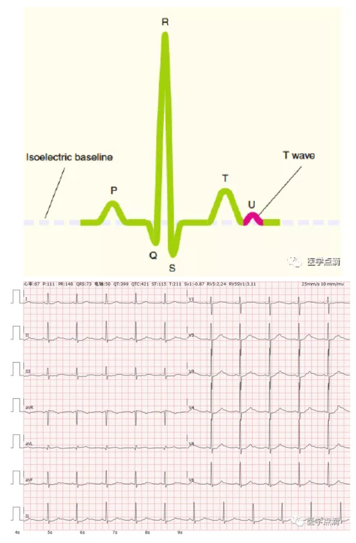 心电图u波明显图片
