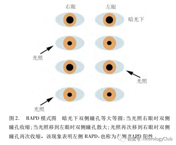 瞳孔大小评估评分图图片