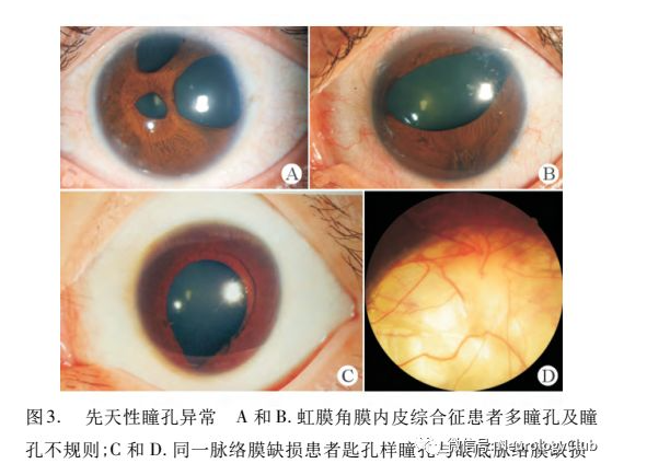 梅毒瞳孔异常图片图片