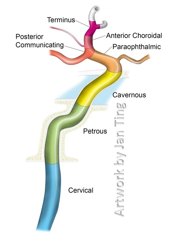 颈内动脉虹吸段示意图图片