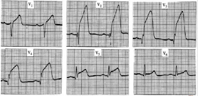 急性st段抬高型心梗心电图的3个基本改变