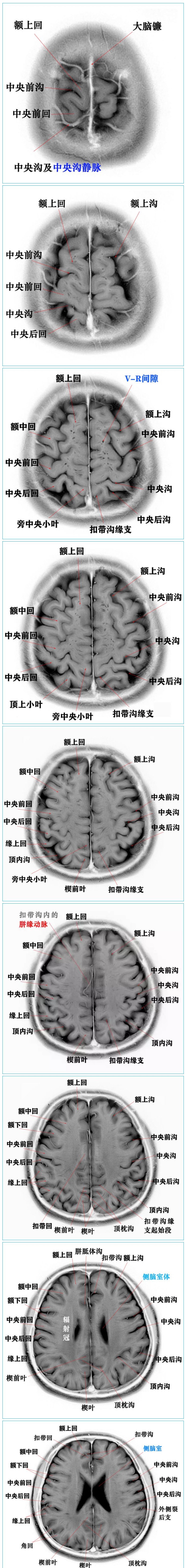 3.0T-T2WI反相图学颅脑断层解剖.jpg