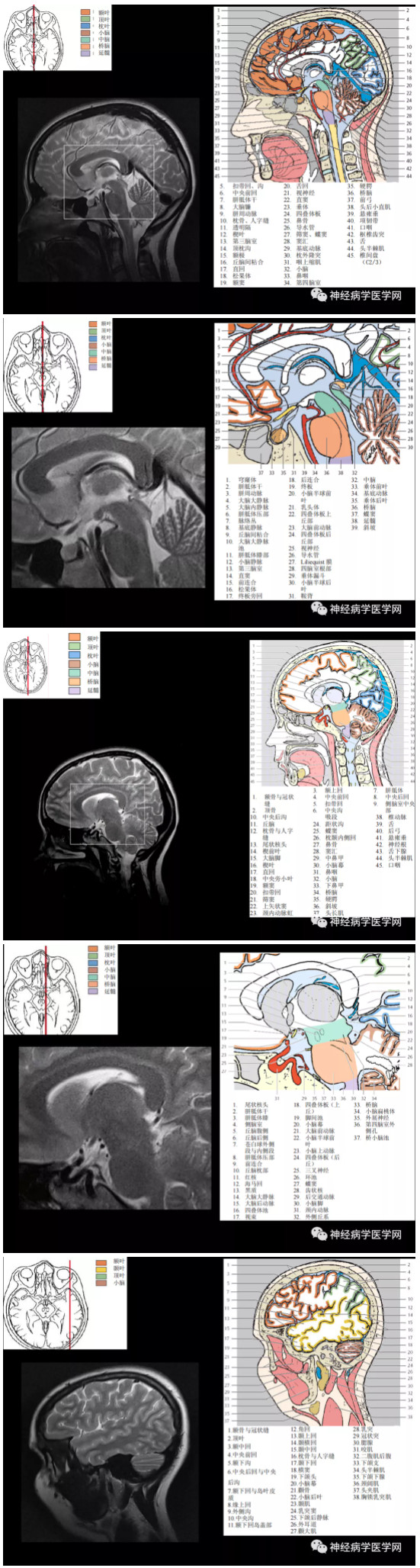 脑CT4.jpg