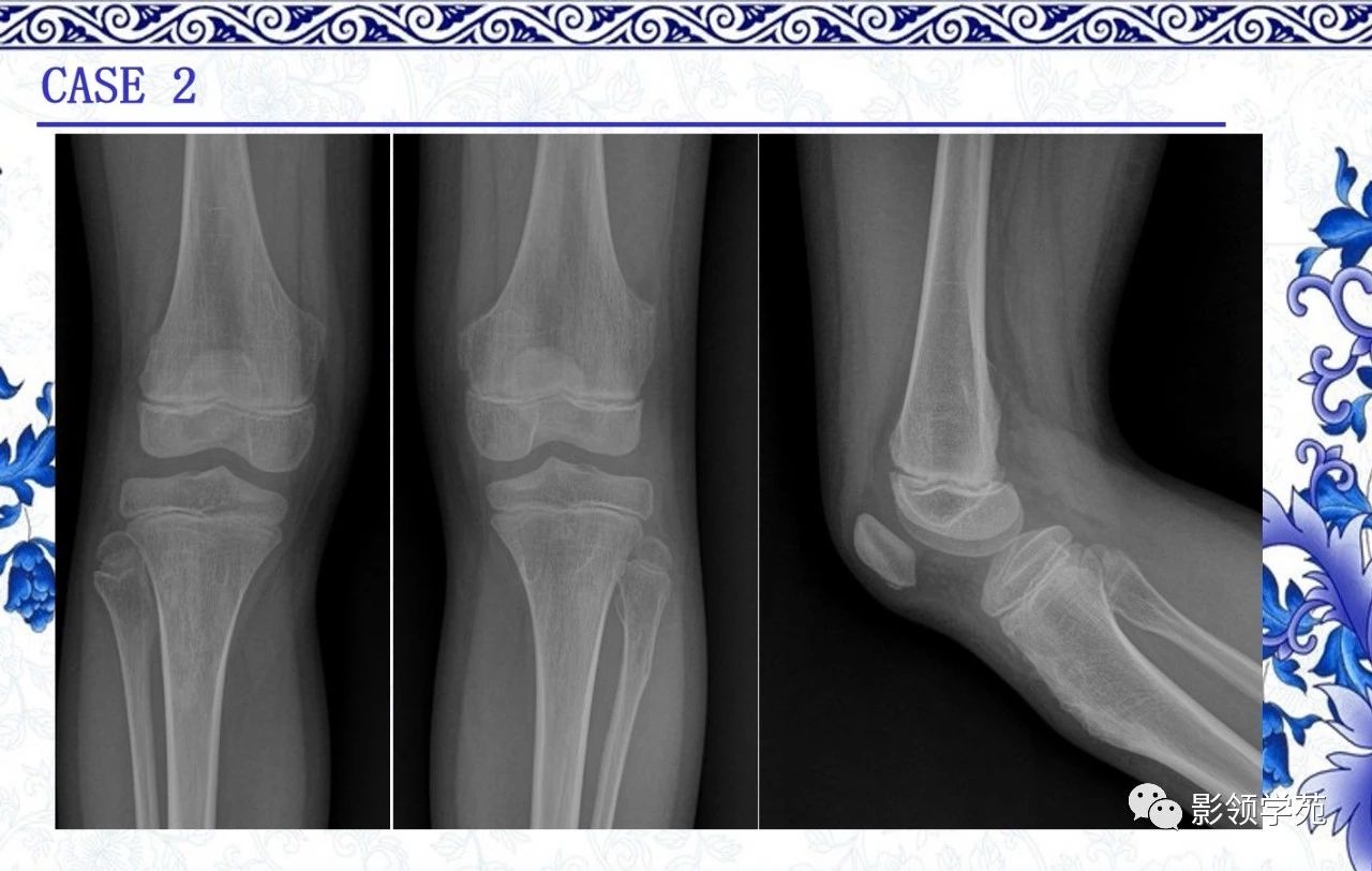 瘤 良性腫瘤,多見於30歲以下,起源於軟骨內化骨的骨骼,長骨幹骺端多見