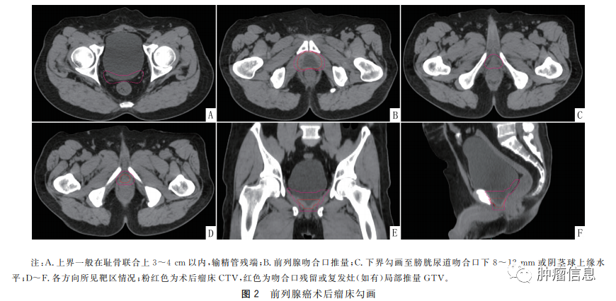 指南精选!前列腺癌术后辅助放射治疗一文读懂!