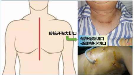 低领切口胸骨后巨大甲状腺肿切除术