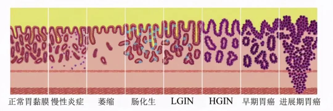 分為輕,中,重3類;其中輕中度的異型增生稱為低級別上皮內瘤變(lgin)