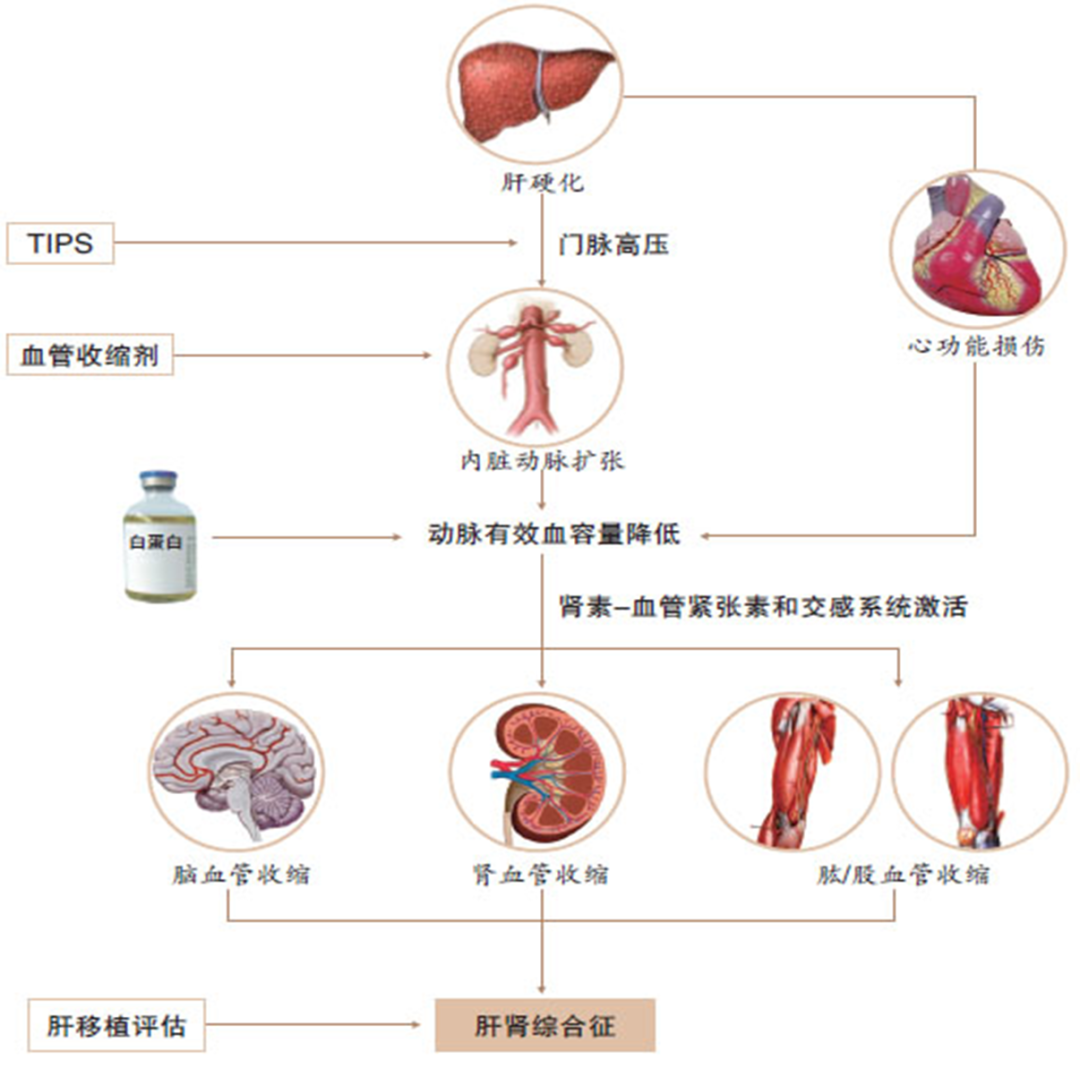 肝腎綜合徵的發病機制及治療策略