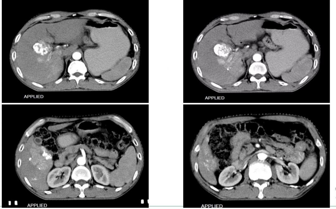 肝癌ct图片怎么看图片