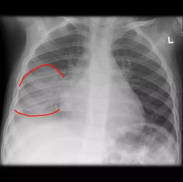 儿童肺炎时胸片怎么看呢