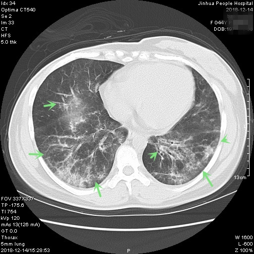 2018.12胸部CT平扫_6.jpg