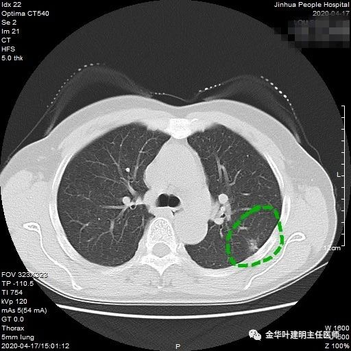肺结节ct片图片图解图片