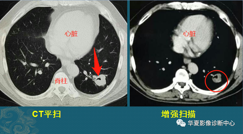 肺结核与肺癌ct片怎么区分教你4个读片小窍门
