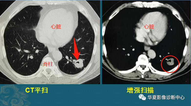 肺结核ct图片图解图片