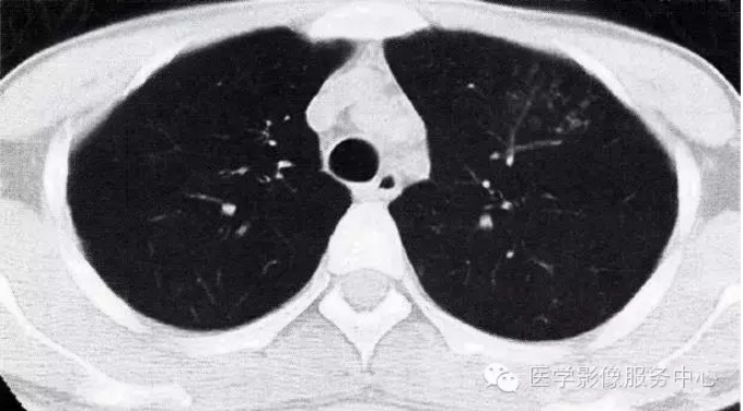 壹生资讯 收藏 肺部炎症的 七大 常见ct表现