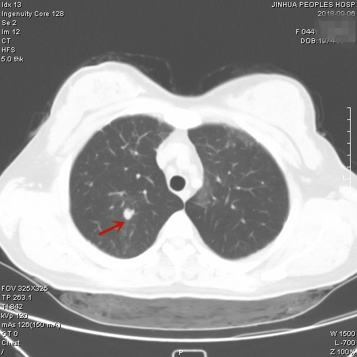 2018.9胸部CT平扫（右上叶结节）_1.jpg