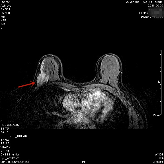 2018.9乳腺MRI_0.jpg