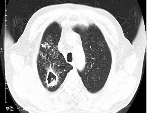 05金葡菌肺炎病例 2:病變進展速度較快,形成多發肺氣囊或小的膿腔