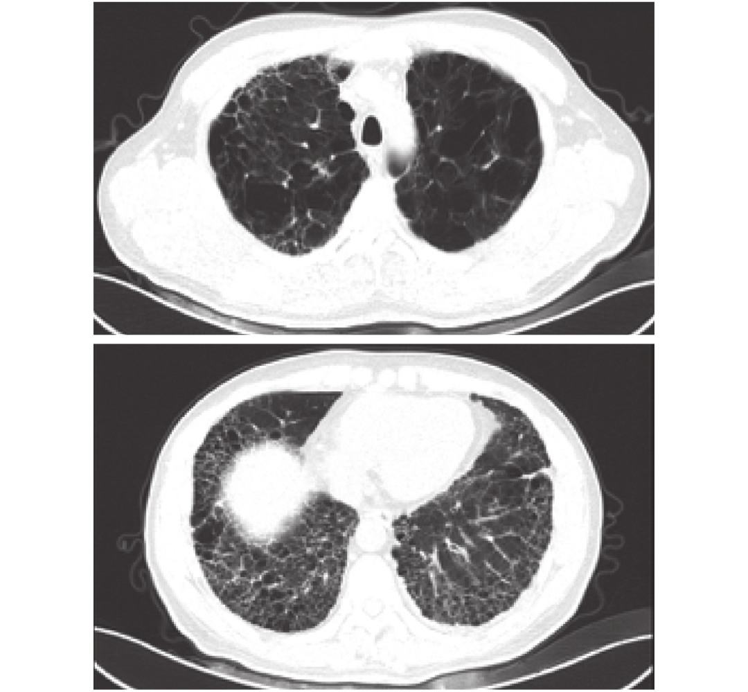 医学笔记|肺纤维化合并肺气肿综合征