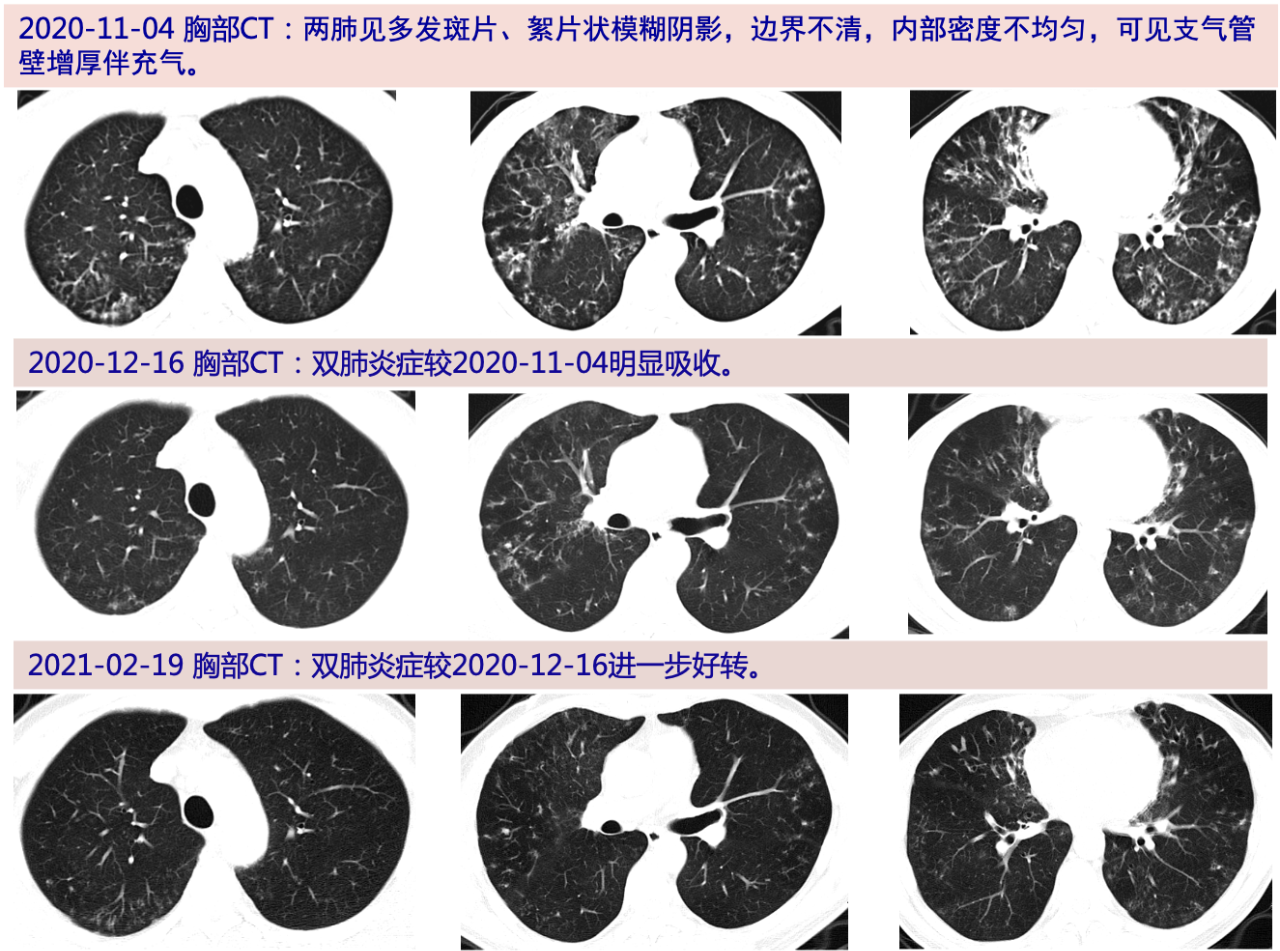 男性,慢性病程,主要表現為反覆咳嗽,咳痰,血白細胞和中性粒細胞正常