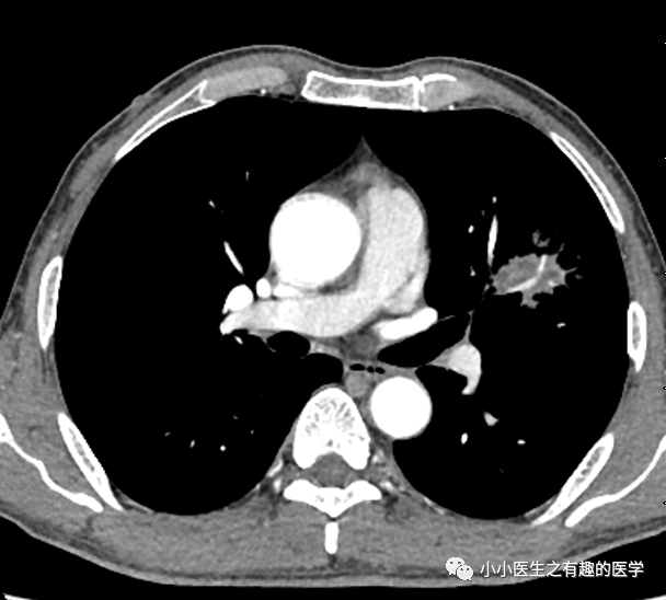 02左下葉背段腫塊,腫塊內也有空洞腫塊內有空洞左上葉舌段腫塊腫塊內