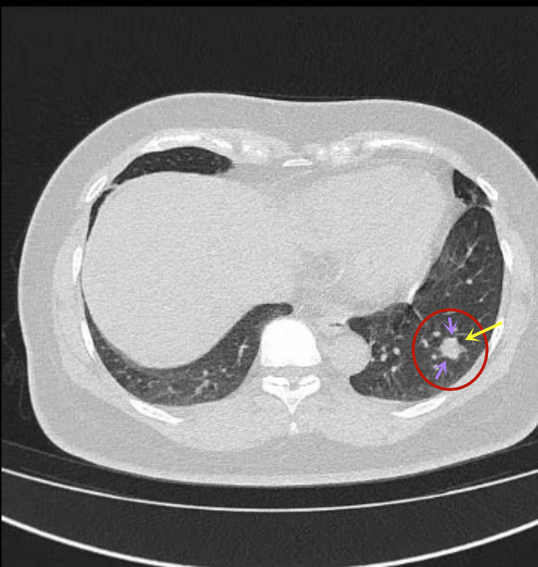 圖6圖5圖4圖3圖2圖1入院前1月餘平掃時的左肺下葉背段小磨玻璃結節,瘤