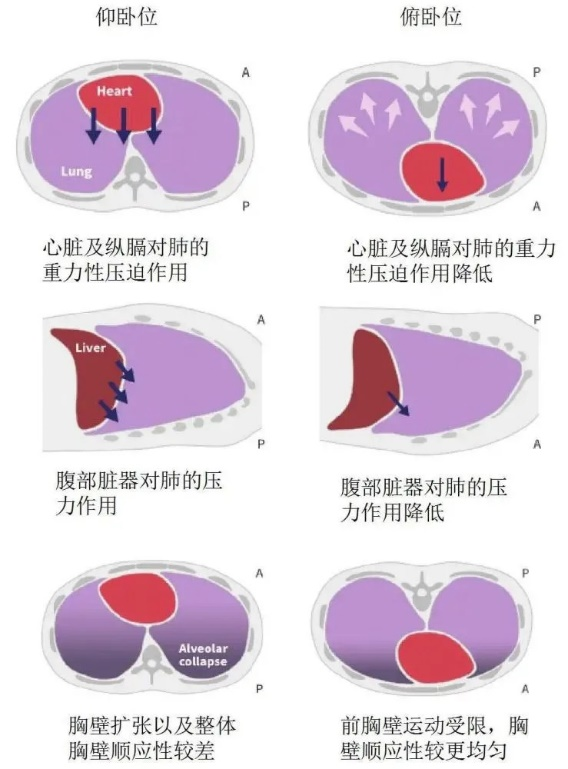 心臟和縱隔對下垂肺區的壓迫,改善肺的順應性,減輕呼吸機相關肺損傷