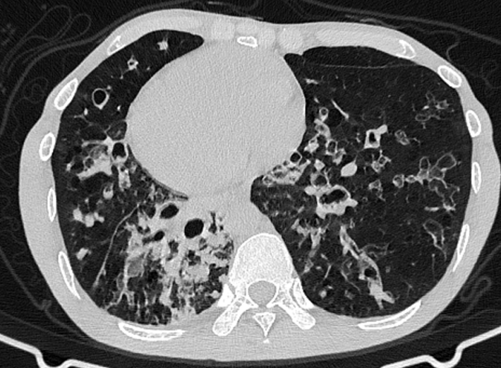 肺部感染影像诊断宝典支气管扩张伴多重耐药铜绿假单胞菌感染1例