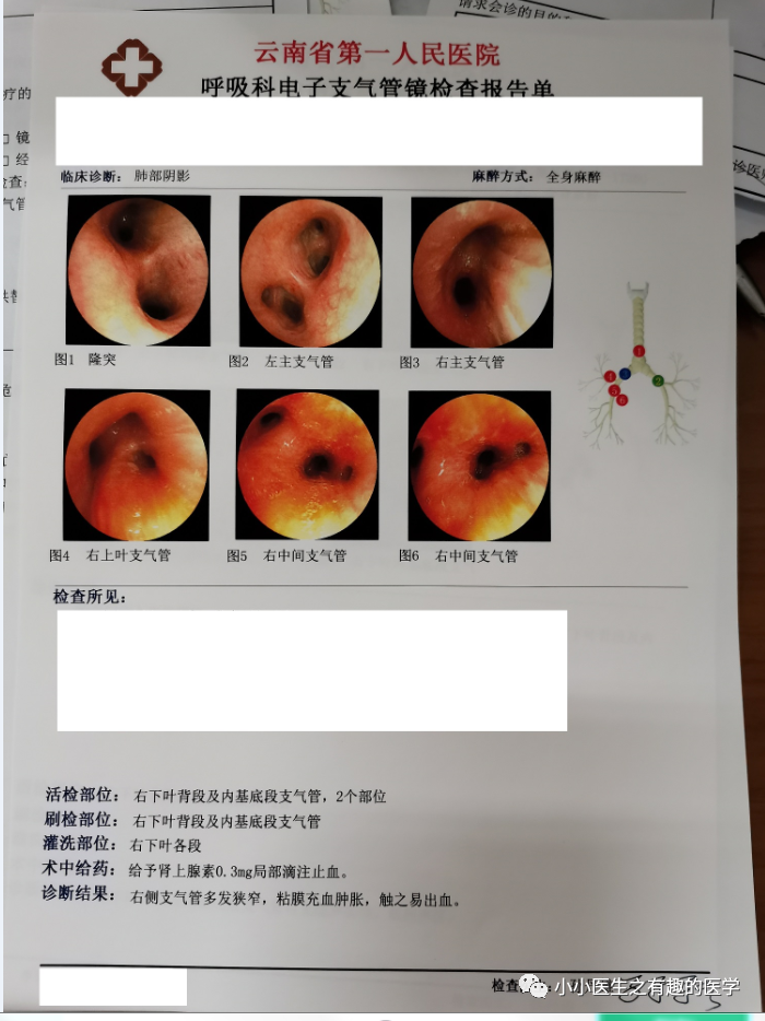 支气管镜肺癌报告图片图片