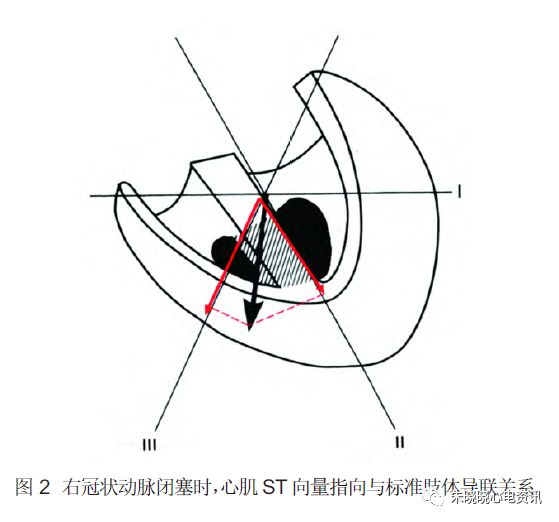 向量的改變,較左迴旋支閉塞所引起的改變更偏向右側(圖2),靠近Ⅲ導聯